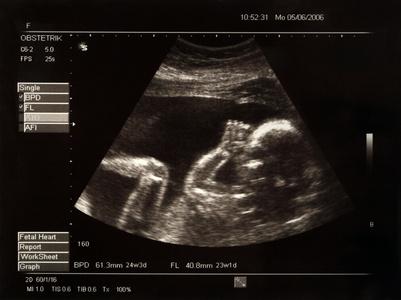 fetus (15K)