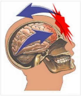 Brain (52K)