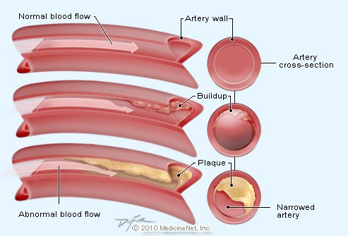 arterywall (51K)